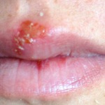 oral herpes simplex